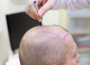 Hair Transplant